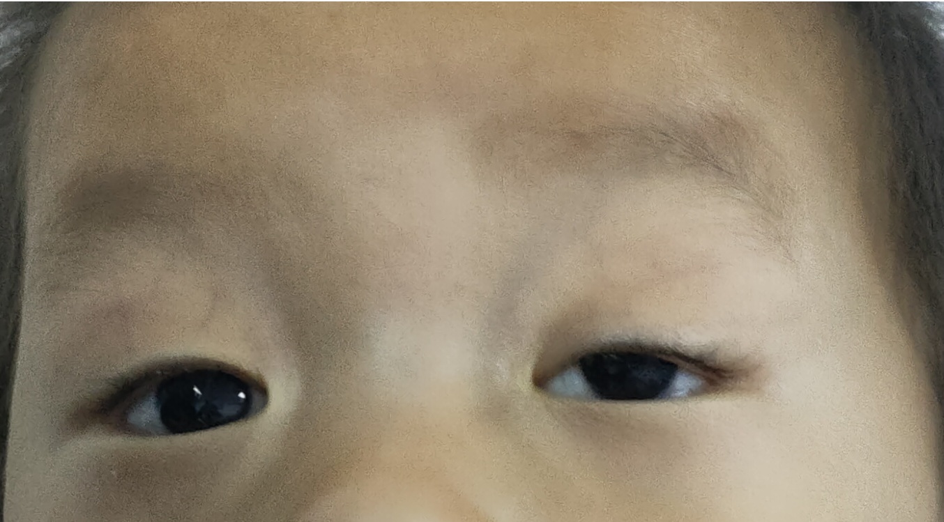 上瞼下垂