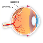 揉眼睛時(shí)出現(xiàn)閃光感是怎么回事？注意！可能是視網(wǎng)膜脫離！